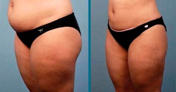 Hilabete batean 10 kilogramo pisua galtzeko metodoak